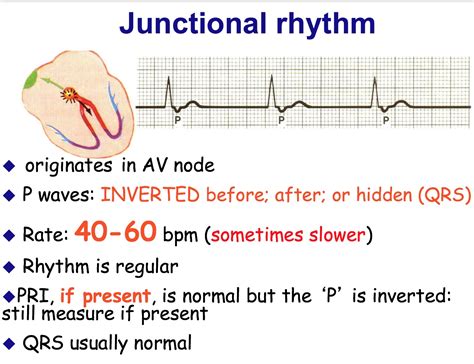 Junctional rhythm: What it is, types, symptoms, and more